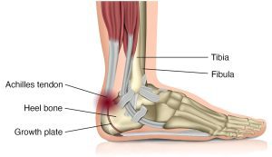 Severs_Childrens_Heel_Pain